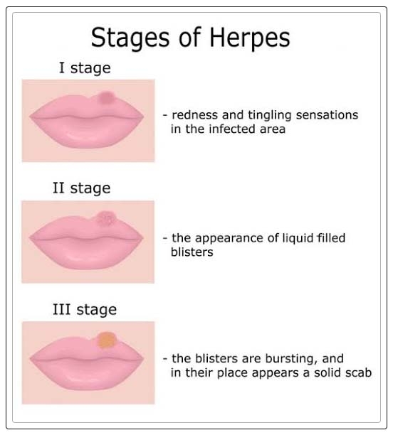 Oral Herpes Causes, Symptoms, Diagnosis, and Treatment REPC