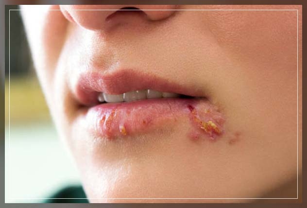 oral herpes