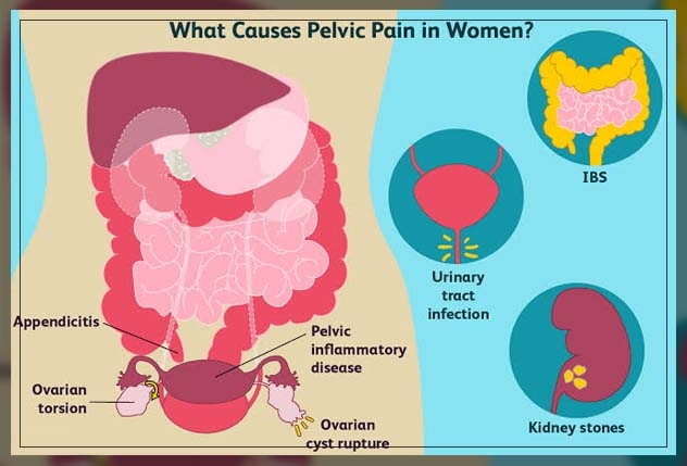 pelvic pain 2
