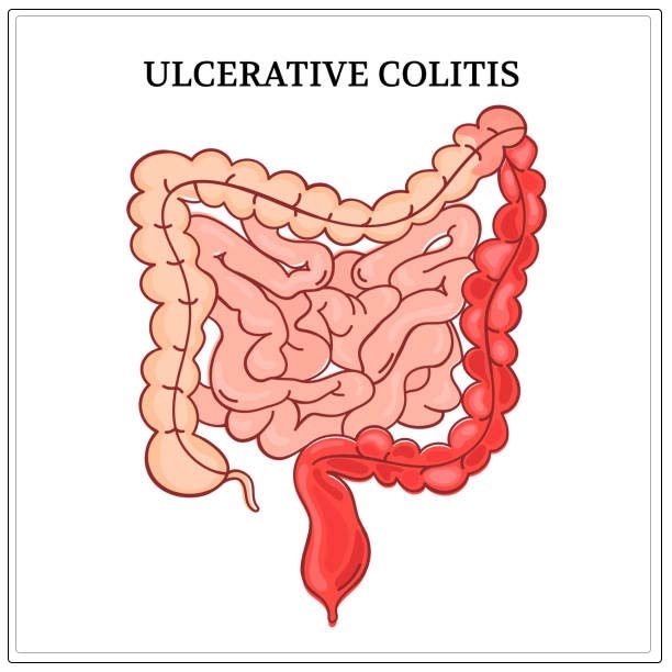ulcerative colitis