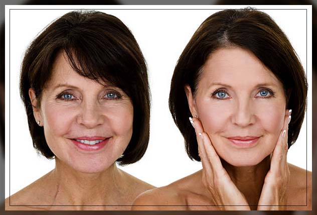 Botox Dubai 6