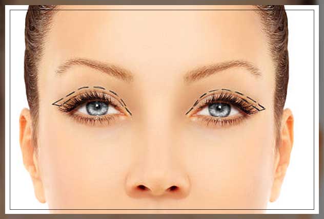 Eyelid surgery 2