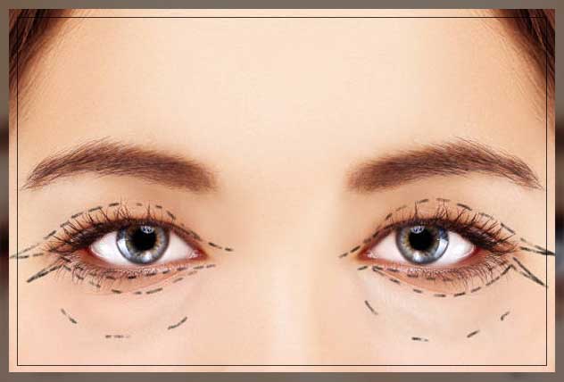 Eyelid surgery 3