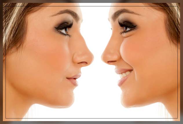 Rhinoplasty Dubai 5