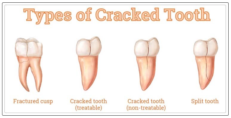 types of cracked tooth