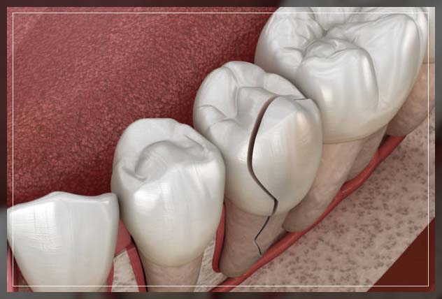 cracked tooth