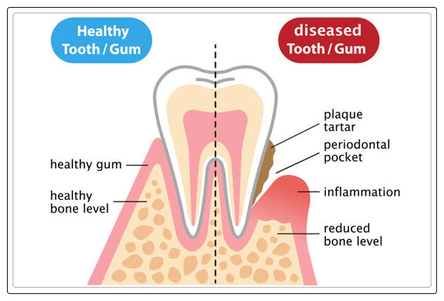 gum disease 5