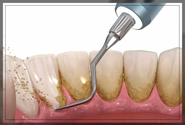 understanding how much is teeth scaling price