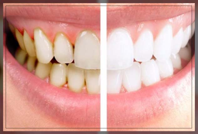 popularity of teeth scaling 