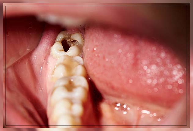 Dental Caries: Treatments, Signs and Symptoms - REPC