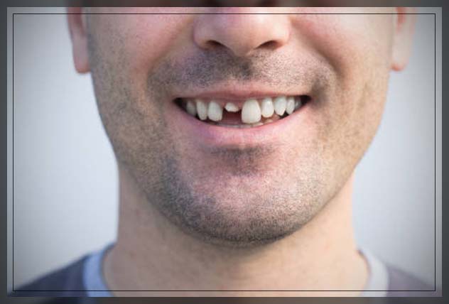 fractured tooth causes