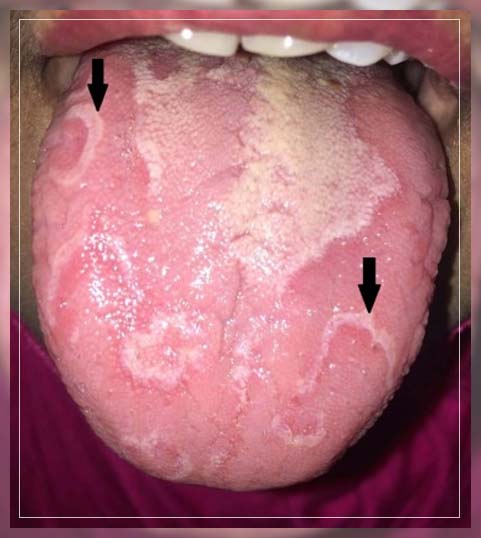 symptoms of white lesions