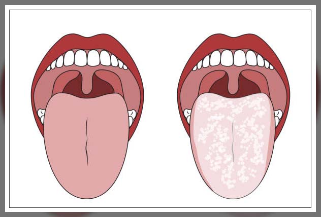 treatment a geographic tongue, before and after