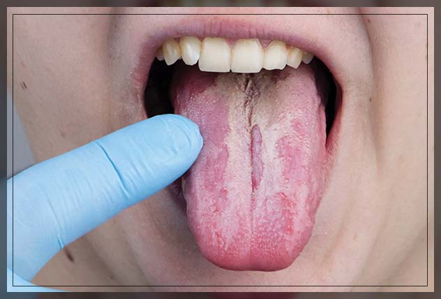 White tongue thrush discount