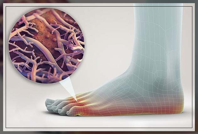 fungal infection causes