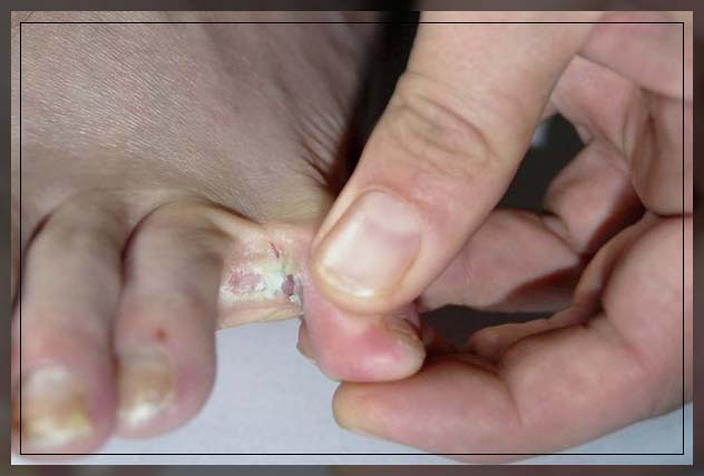 athlete's foot diagnosis