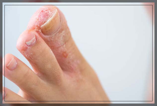 athlete's foot treatment