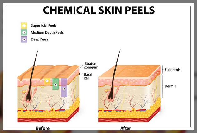 chemical peel types