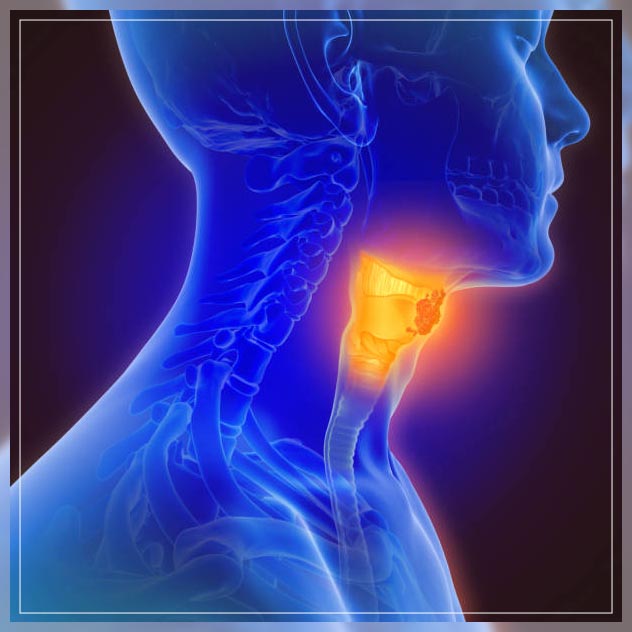 throat cancer