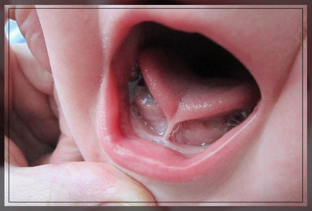 importance of tongue tie treatment