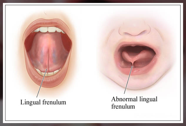 lingual frenulum causes it 