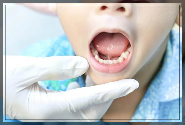 when tongue is tied to bottom of the mouth