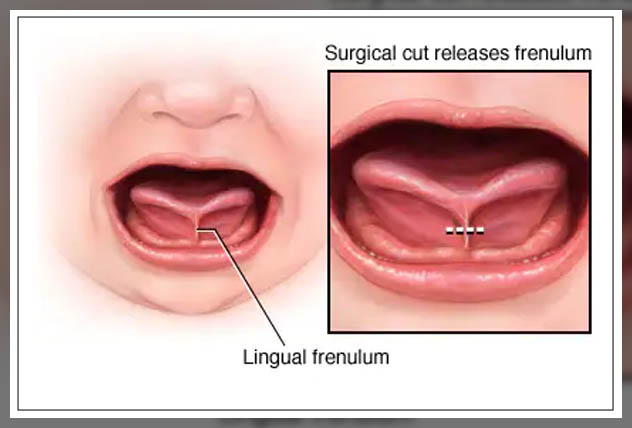 analyzing treatment for tongue tie