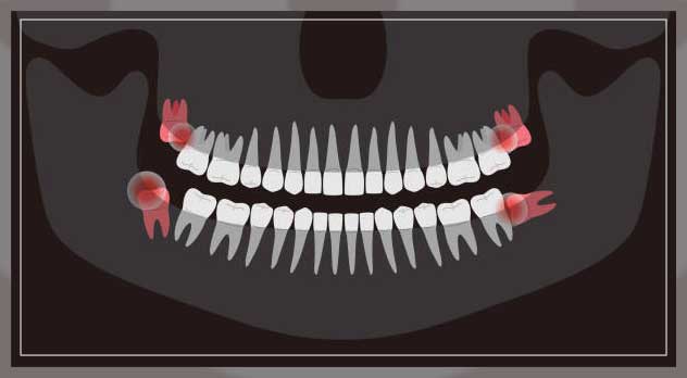 Wisdom tooth pain 11