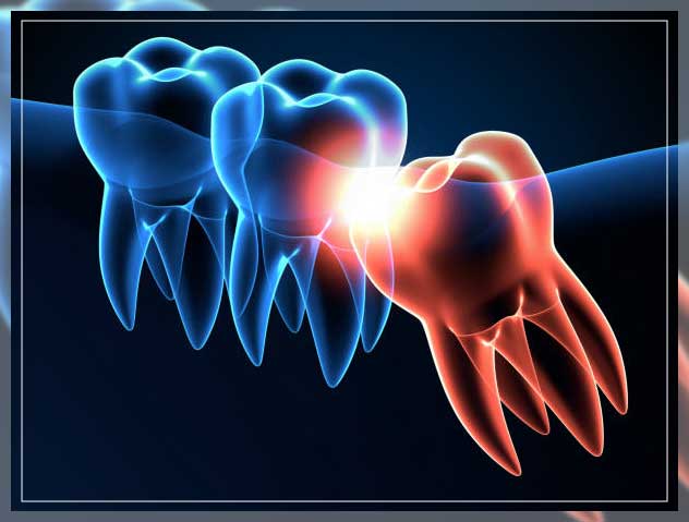 Wisdom tooth pain 12