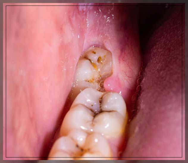 Wisdom tooth pain 15