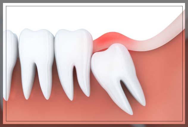 Wisdom tooth pain 7