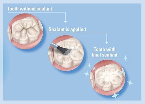 dental sealants 1