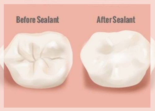 dental sealants 2