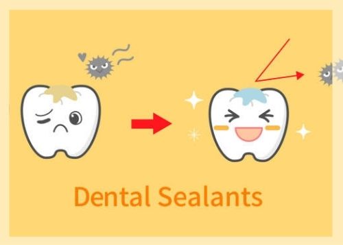 dental sealants