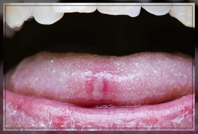 always biting tongue symptoms