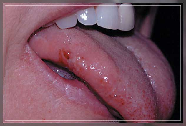 medical treatment for bites