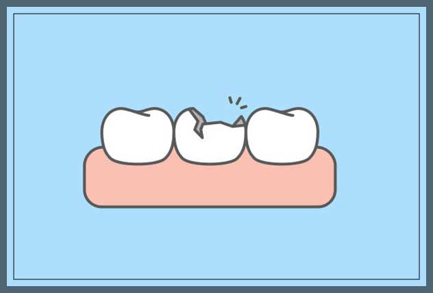 chipped tooth