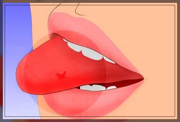 preventing tongue bites