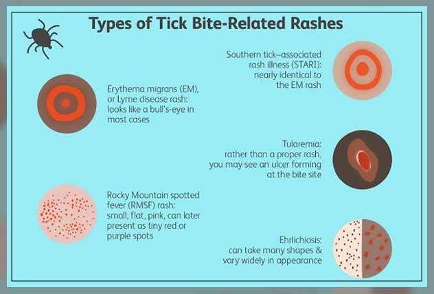 tick bites 2