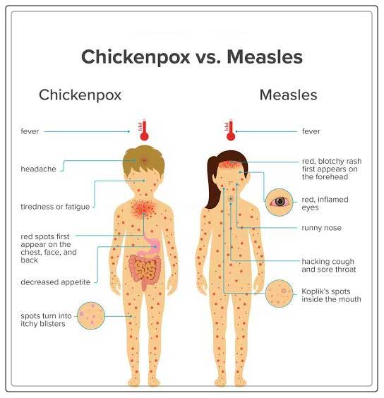 vs. measles