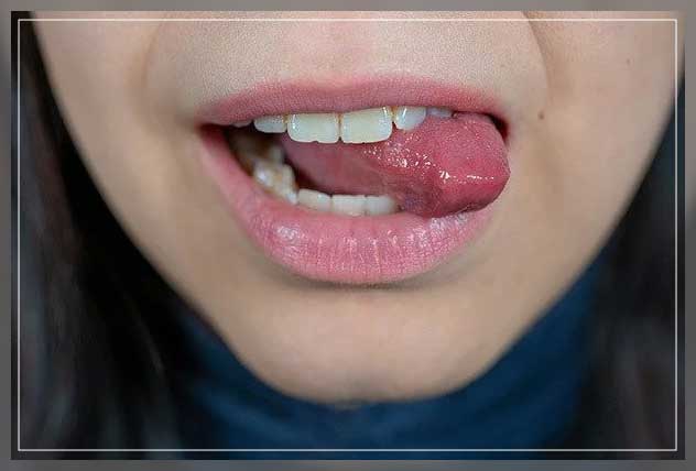 woman always biting tongue leading to sore on tongue
