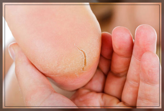 treatment of cracked heels