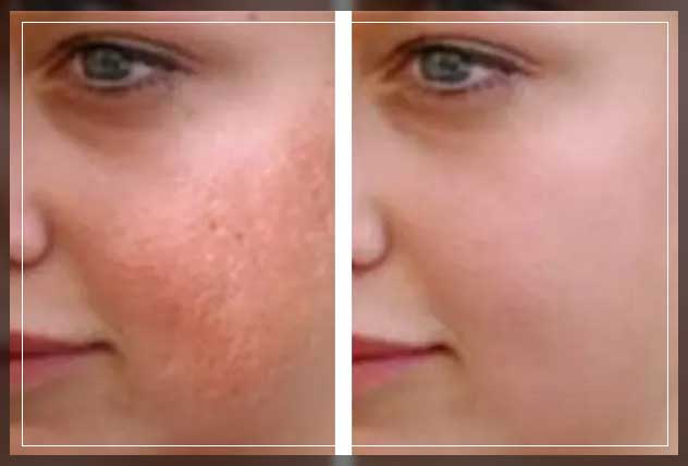 laser facial before and after care