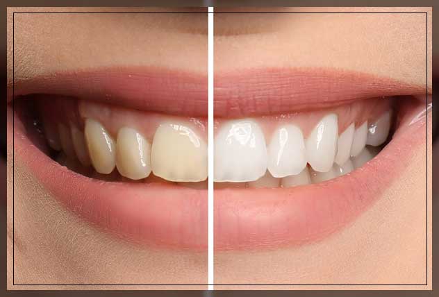 after teeth whitening results