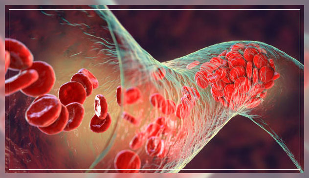 deep vein thrombosis 1