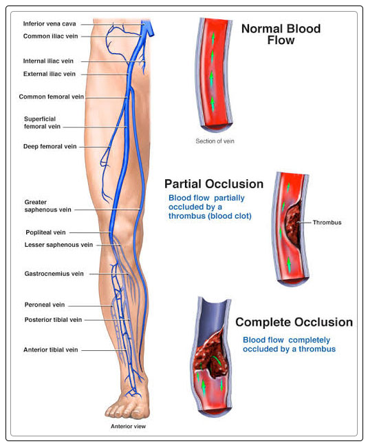 deep vein thrombosis 2