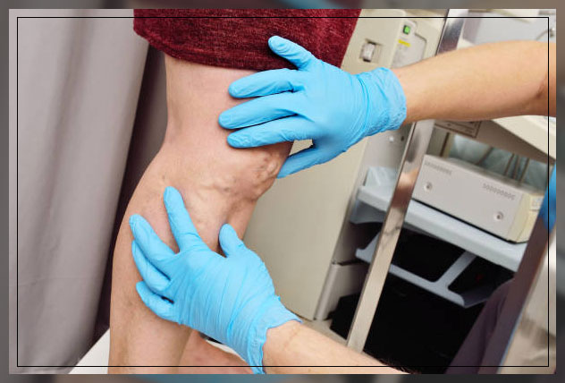 deep vein thrombosis 3