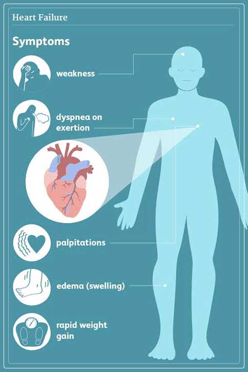 heart failure 3