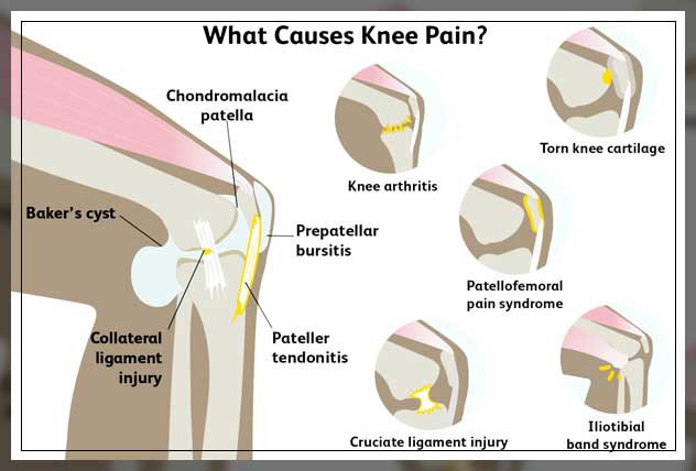 knee pain 1