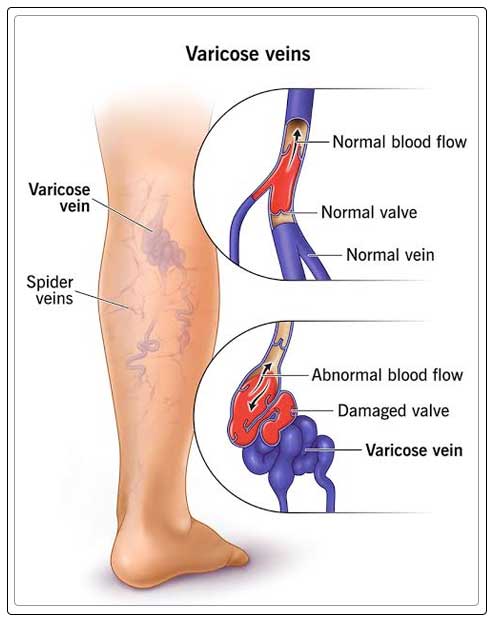 spider veins 1